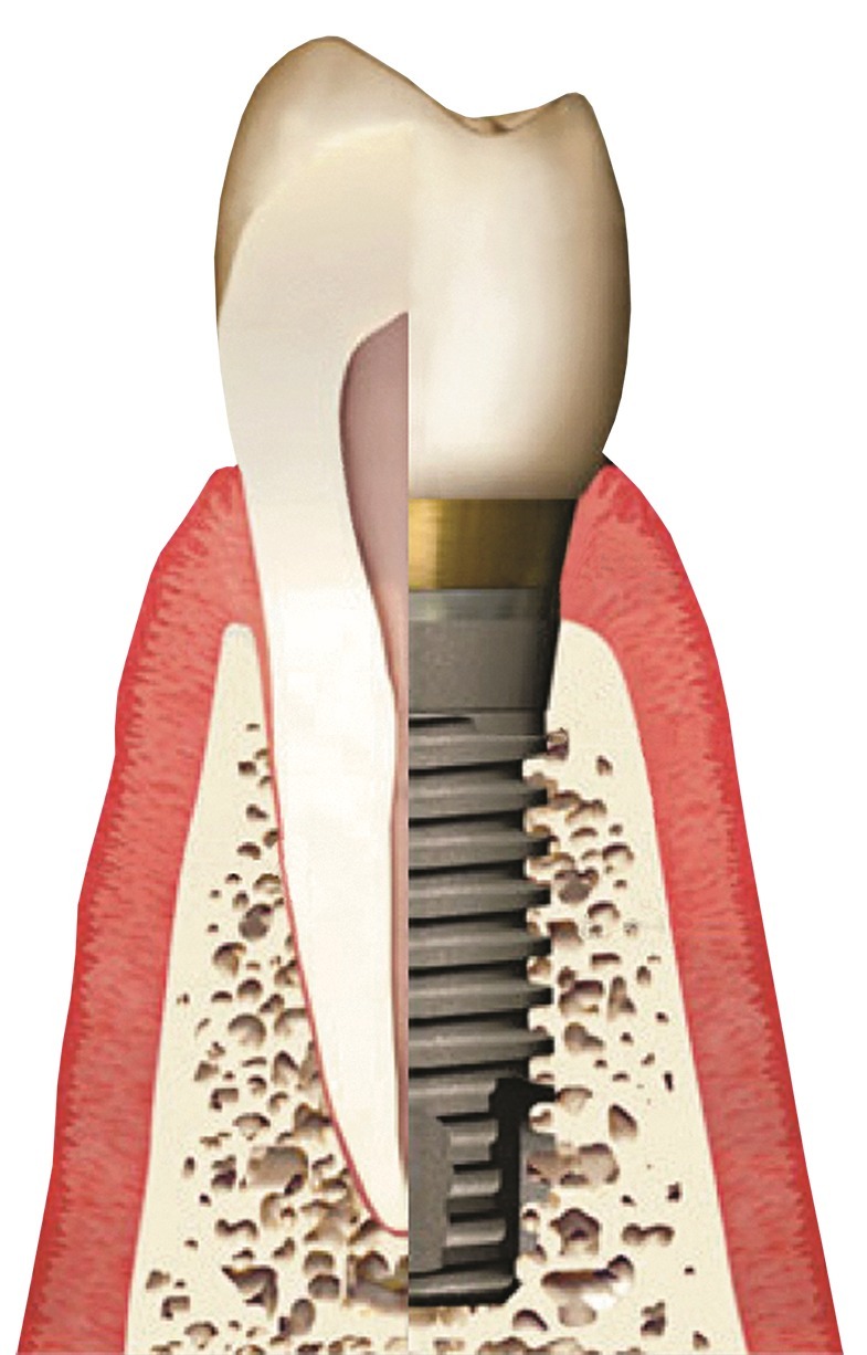 3D illustration of dental implant compared to natural tooth